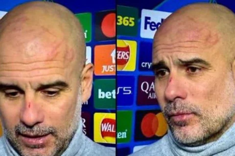 UCL: I want to hurt myself – Guardiola reacts to scratches on his nose, face